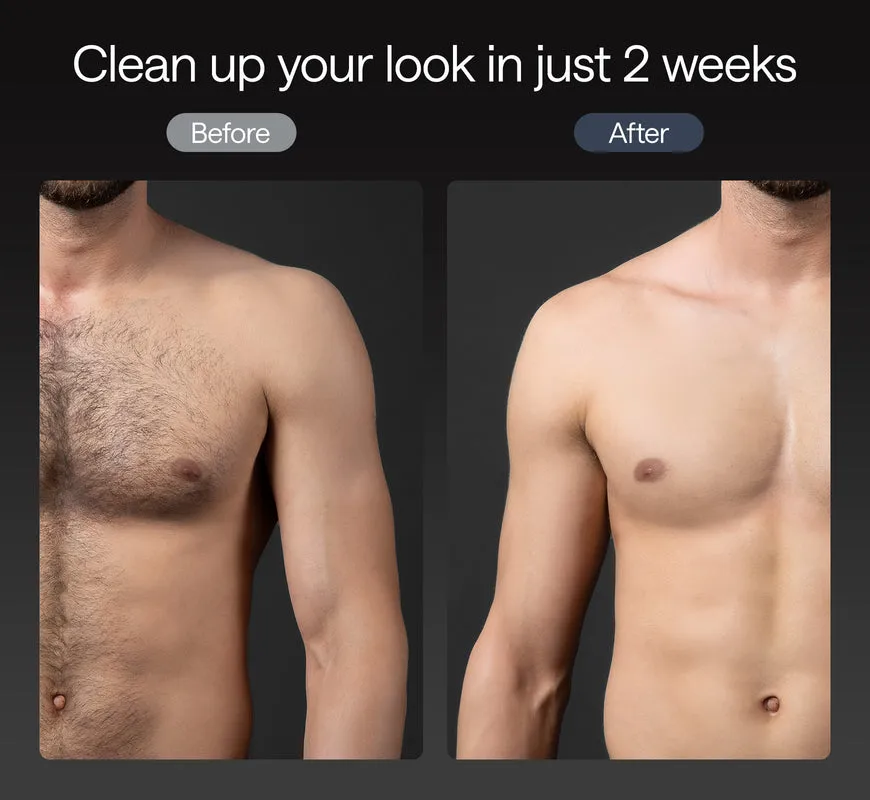 Ulike X IPL Hair Removal for Men — image 2